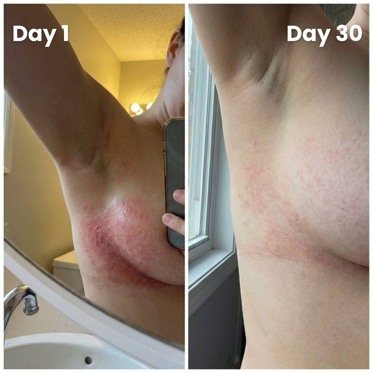 Intertrigo Relief Cream